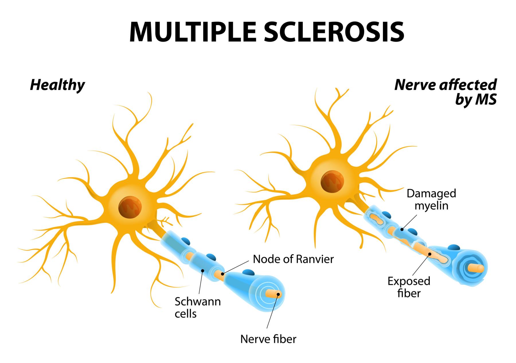 multiple sclerosis